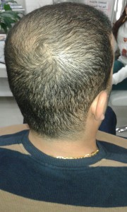 Bild på hjässan från en man om gjort hårtransplantation i Turkiet med Hairistanbul